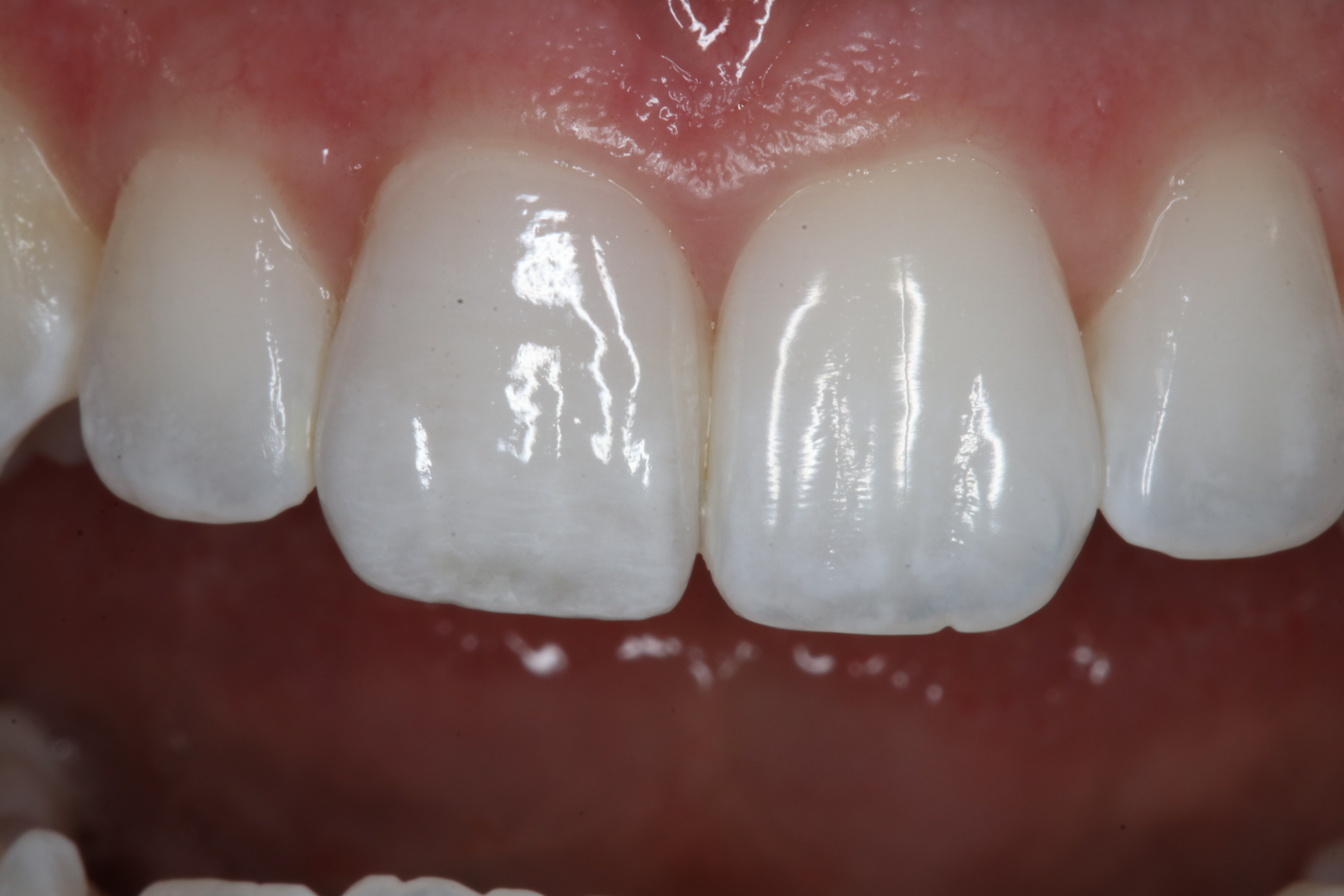 Porcelain veneer incredibly life like dental restoration for a smile makeover