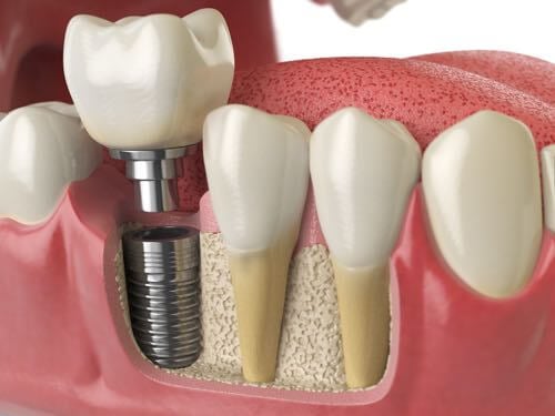 Dental-Implant-500-x-375-2